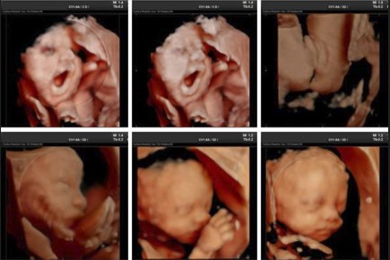 Ecografía 4D — Imagen 17