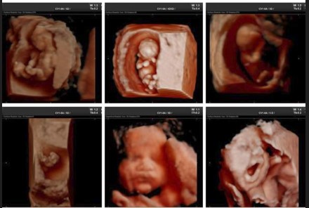 Ecografía 4D — Imagen 19