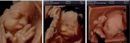 Ecografía 4D — Imagen 2