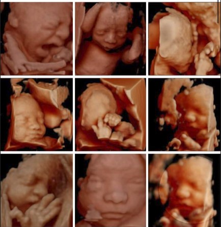 Ecografía 4D — Imagen 21